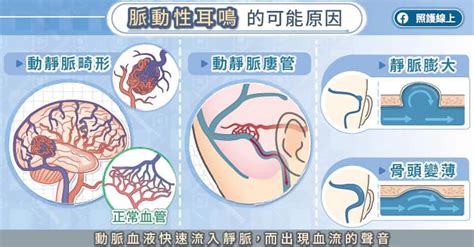 適脈旺耳鳴|神經外科醫師圖文解說：吵到睡不著！「脈動性耳鳴」。